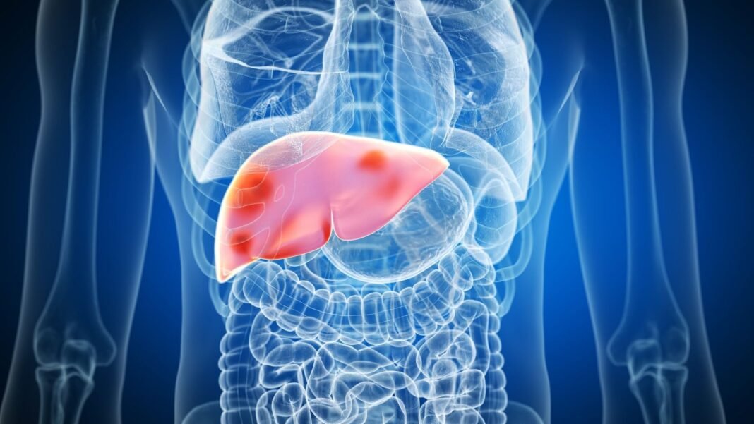 7 ways to manage non-alcoholic fatty liver disease